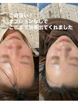 スムー 金沢小橋町店(Smoo)/肌質改善　陶肌トリートメント