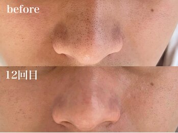 ビエント(VIENTO)/毛穴ケア継続の結果がここに！！