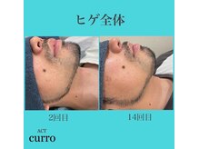 アクト クロ(ACT curro)/【ヒゲ全体】脱毛施術例