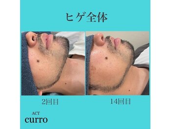 アクト クロ(ACT curro)/【ヒゲ全体】脱毛施術例