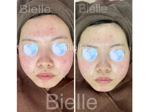 ビエル(Bielle)/原因不明のニキビケア経過