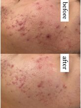 キュル(Kyul)/REVIハーブピーリング