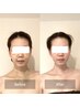 人気No1★【顔吸引専用】むくみ改善No. 1顔術後モニター