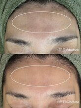 サロンドジェシカ(salon de Jessica)/プラズマフェイシャル