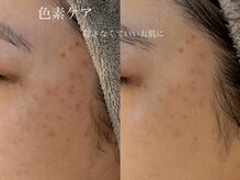 シェア(share.)/ニキビ肌改善！美白