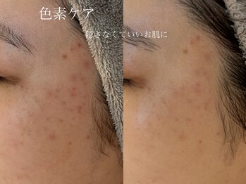 シェア(share.)/ニキビ肌改善！美白