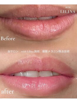 ウィズリリナ 新横浜(with Lilina.)/ローマピンク　症例　術後1ヶ月