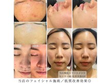 サロン ド ボーテル ヴィ(salon de beaute REVI)の雰囲気（【人気No.1ハーブピーリング】男女肌悩み問わず肌質改善効果◎）
