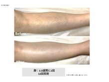 ラレピア(LA LEPIA)/お客様BeforeAfter☆