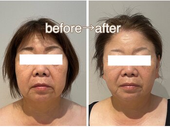 ラディアンス/小顔たるみ特化フェイシャル