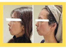 アン 銀座(ann)/レモンボトル