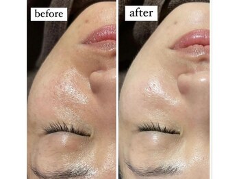 薫風 大阪豊中店/毛穴洗浄【女性】