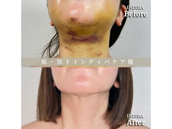 術後の女神 大阪本町店/ダウンタイムケア・インディバ