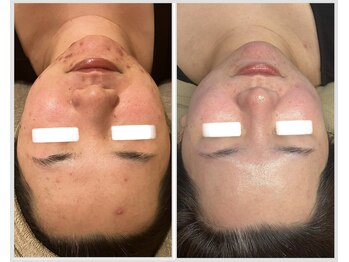 美しぐれ 溝の口店/【1年】LDM/ピーリング/プラズマ