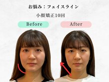 美容整体ウェリナ 中川八田院/.【小顔矯正before→after】