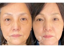 エルビービュティーサロン(LB BEAUTY SALON)/【ニキビ改善】ハーブピーリング