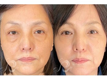 エルビービュティーサロン(LB BEAUTY SALON)/【ニキビ改善】ハーブピーリング