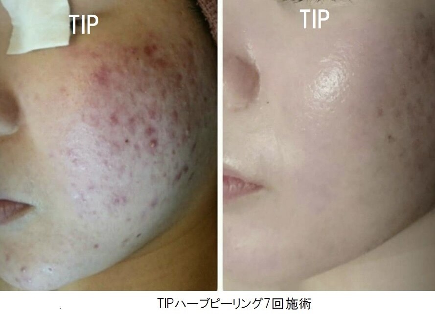 ハーブピーリングbeauty page1 C033288517.jpg?impolicy=