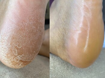 #けあなちゅらるの写真/【エスプランニング認定サロン★】最新技術！韓国式足裏角質ケアで赤ちゃんのようなぷるぷるフットへ★