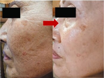 ブリリアン デイスパ 阪急西宮ガーデンズ店(BRILLIAN DAYSPA)/水光ピーリング