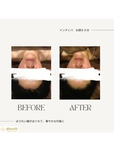 グランツ 小山店/インディバフェイシャル60分