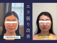エレミュー 烏丸(Elemue.)/30代　《エラ改善》