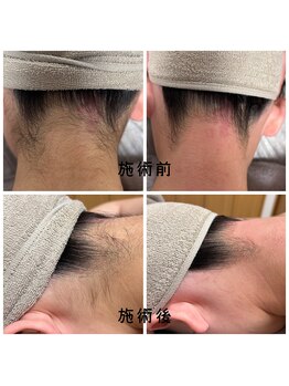 フルールスレーヌ(Fleur Sereine)/シュガーリング&光でダブル脱毛