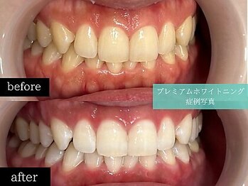 ホワイトニングカフェ 福岡天神店/◎歯のホワイトニング施術写真◎