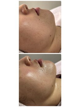 リアスキン(Lia skin)/短時間でリフトアップも叶う