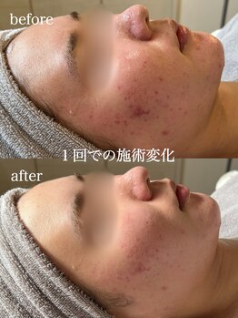 ルラシェ(Relacher)/温石×ハーブ×ポレーション導入