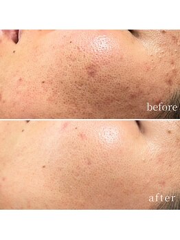 ソレイユ(Soleil)/毛穴・角質ケア