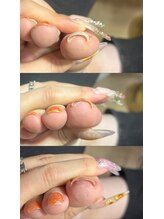 ラズリ(Lazuri)/器具をつけない巻き爪矯正