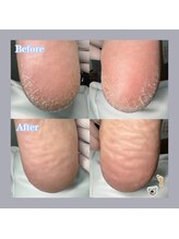 巻き爪補正店 大阪梅田駅前店/寒くなると乾燥でガサガサに、、