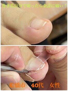 巻き爪じゅん 船橋店/巻き爪自分で切ったら余計ツラい