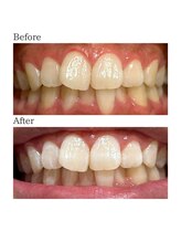 ノーブル 上土店(Noble)/ホワイトニングBeforeAfter