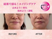 ブルーム(BLOOM)の雰囲気（たるみが改善すれば、小顔になる！10年前のフェイスラインに！）