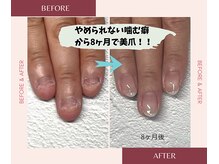 ブルームブルーム(BLOOMブルーム)/やめられなかった噛む癖