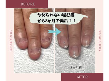 やめられなかった噛む癖