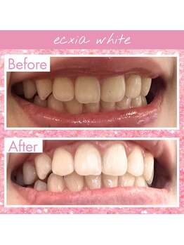 エクシアホワイトニング 高崎店/ホワイトニング