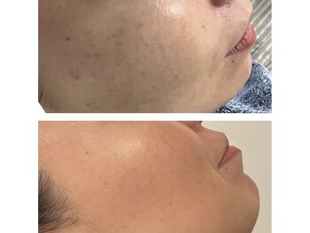 シミケア アンド 痩身専門　恵比寿の写真/輝く透明感あふれる肌へ！韓国美容好きに捧ぐララピール施術◎
