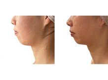 メリア(Mellia)/小顔リフトアップ最高峰