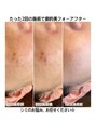 ソレイユ(Soleil) 名古屋市3店舗のみの光フェイシャル◇