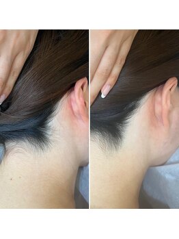 インベスト(INVEST)/うなじ脱毛