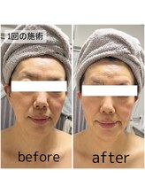 きれい塾 恵比寿/低周波リフト