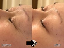 エビアス(Evias)/1回でも感じる効果◎しわ改善