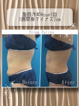 プリマプリート 各務原店/脂肪冷却4CUP1回でこの効果！