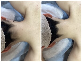 ルルトウキョウ 池袋店(LULU.tokyo)/うなじ脱毛