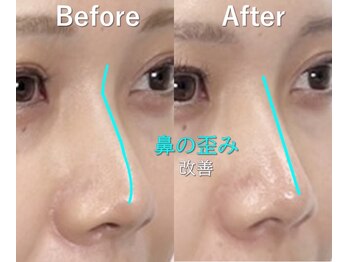 ラプリ 大宮店(Raplit)/隆鼻＋輪郭矯正40分10回