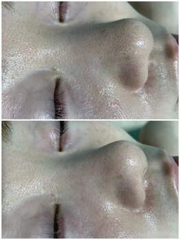 ファーファラ(Farfalla)/毛穴洗浄ハイドラフェイシャル