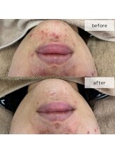 ヴィーナス(Venus)/エステ版ポテンツァ　3回